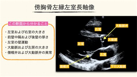 心エコーの基本断面① .